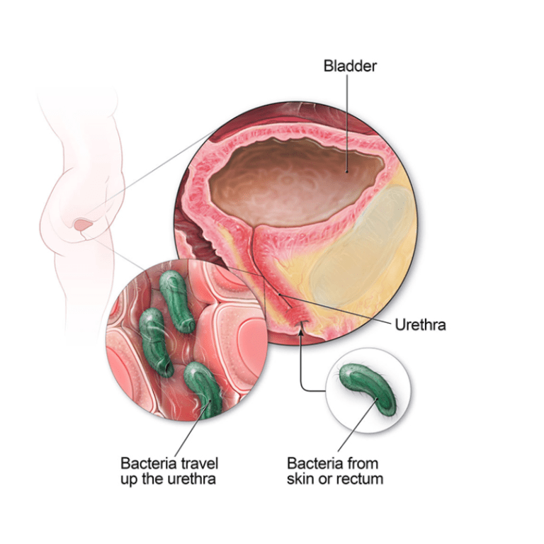 Urinary Infection (UTI)