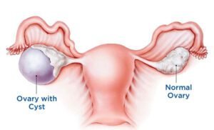 Ovarian Cysts Treatment
