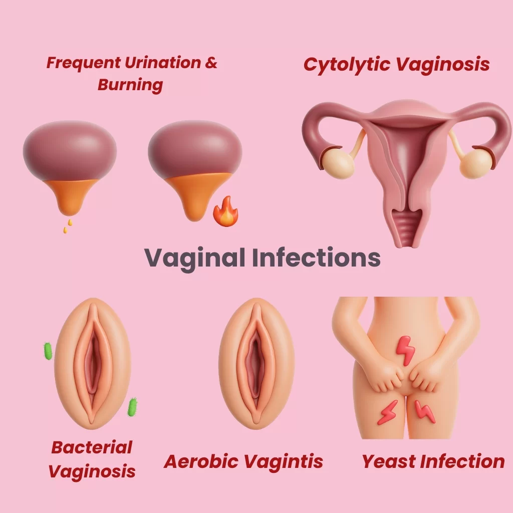 Vaginal Infection