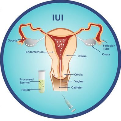 IUI Treatment (Intrauterine Insemination)