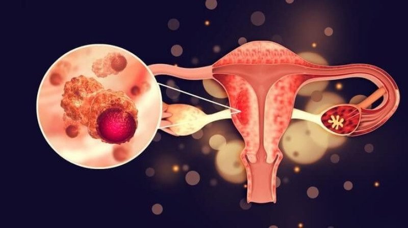 Ovarian Cancer-drvijayalaksmigynecologist