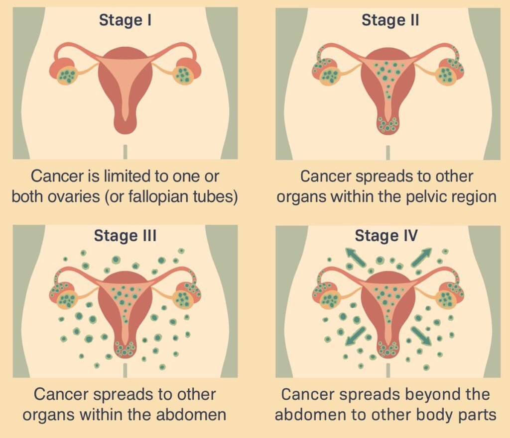 Explaining about stages of ovarian cancer-drvijayalaksmigynecoogist