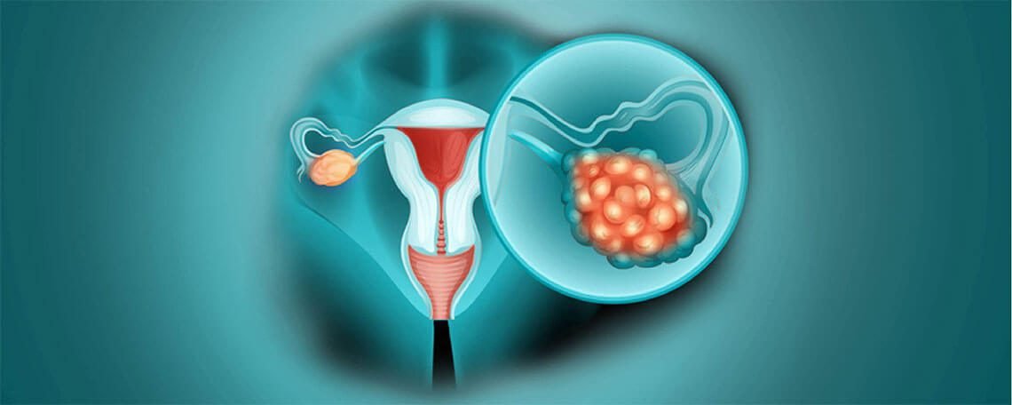 Ovarian cancer-drvijayalaksmigynecologist